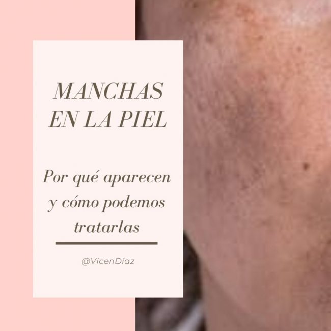 manchas en la piel por el sol
